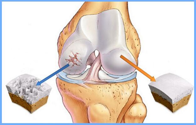 Kniegelenk normal und von Arthrose betroffen