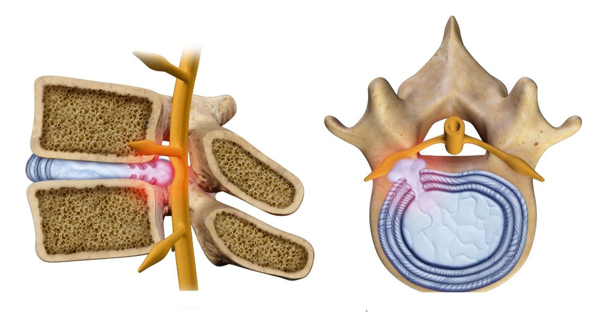Wirbelsäulenhernie bei thorakaler Osteochondrose