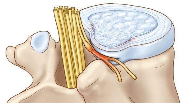 Eine lumbale Osteochondrose kann zu Komplikationen in Form eines Zwischenwirbelbruchs führen