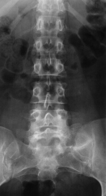 Zur Diagnose einer lumbalen Osteochondrose wird eine Röntgenaufnahme durchgeführt