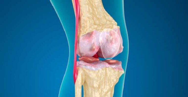 Arthrose der Kniegelenkkrankheit, die die Zerstörung des Knorpels in den Gelenken verursacht