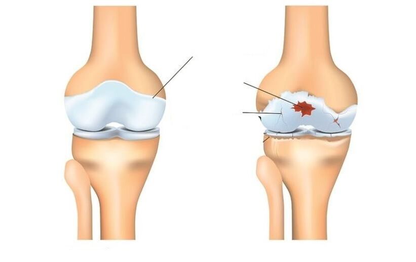 Gesunde und Patient mit Arthrosis Gelenke